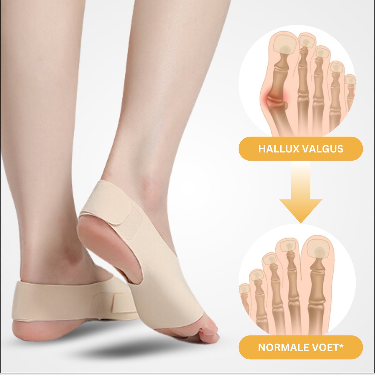 Hallux Valgus Bunion Grote Teen Spalk 2 Stuks